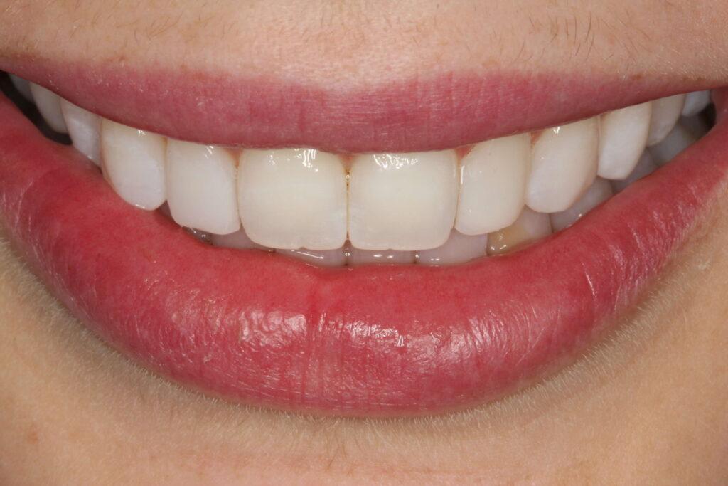 Teeth Whitening in St Helens