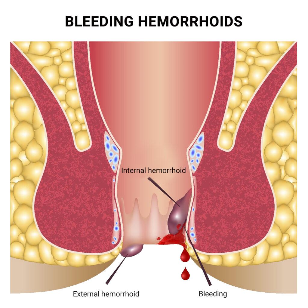 Hemorrhoids Surgery Demystified: What You Need to Know